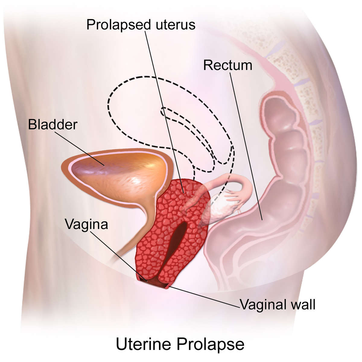 Prolapse uterus
