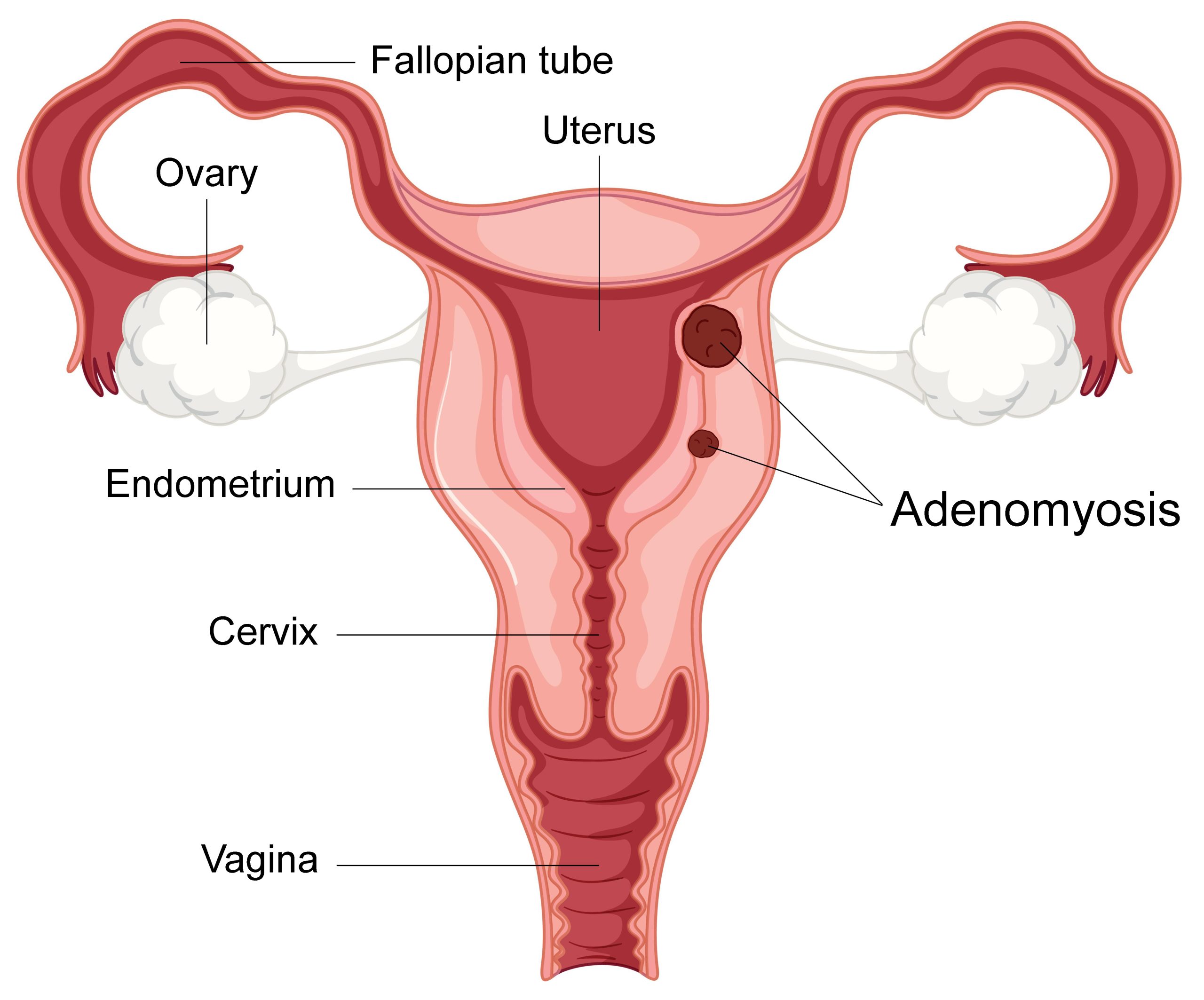 Adenomyosis Treatment in Kharghar
