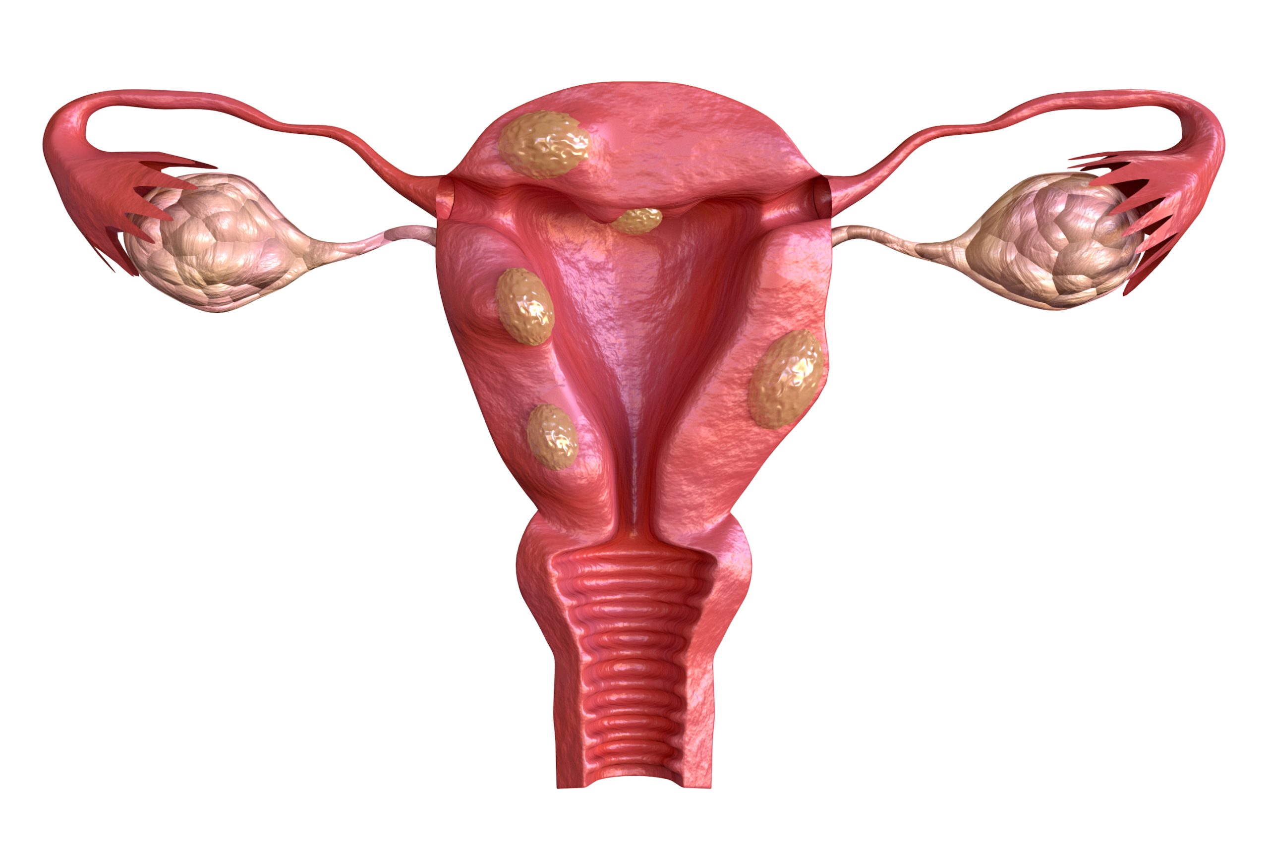 Fibroid removal in Navi Mumbai