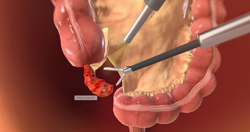 Appendix surgery in Navi Mumbai