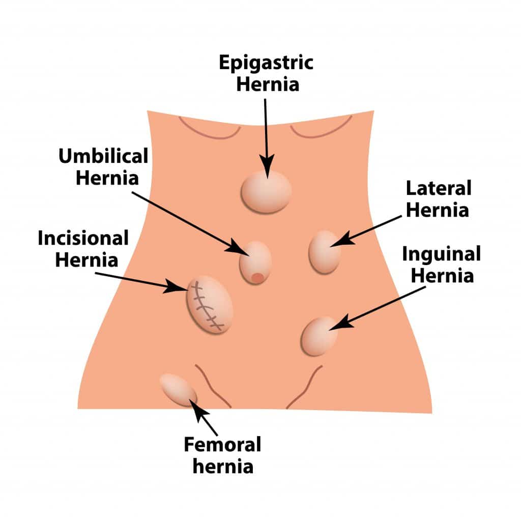 Hernia surgeon in Navi Mumbai