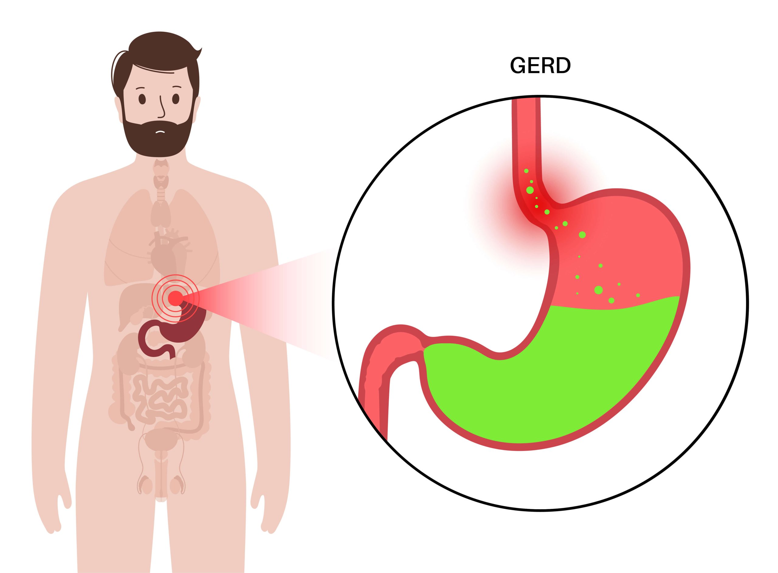 Acid Reflux in Navi Mumbai