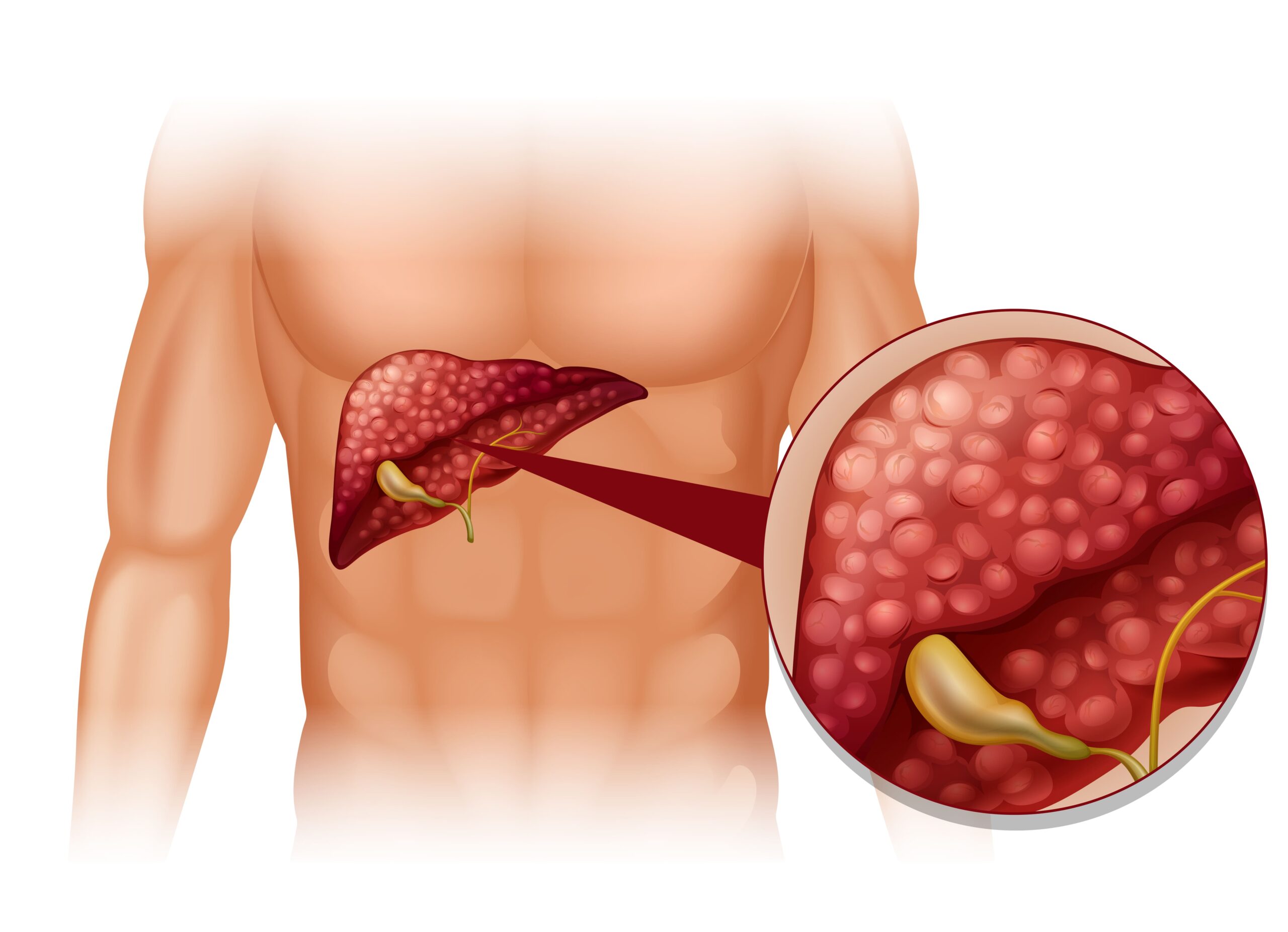 Gallbladder surgery in Navi Mumbai