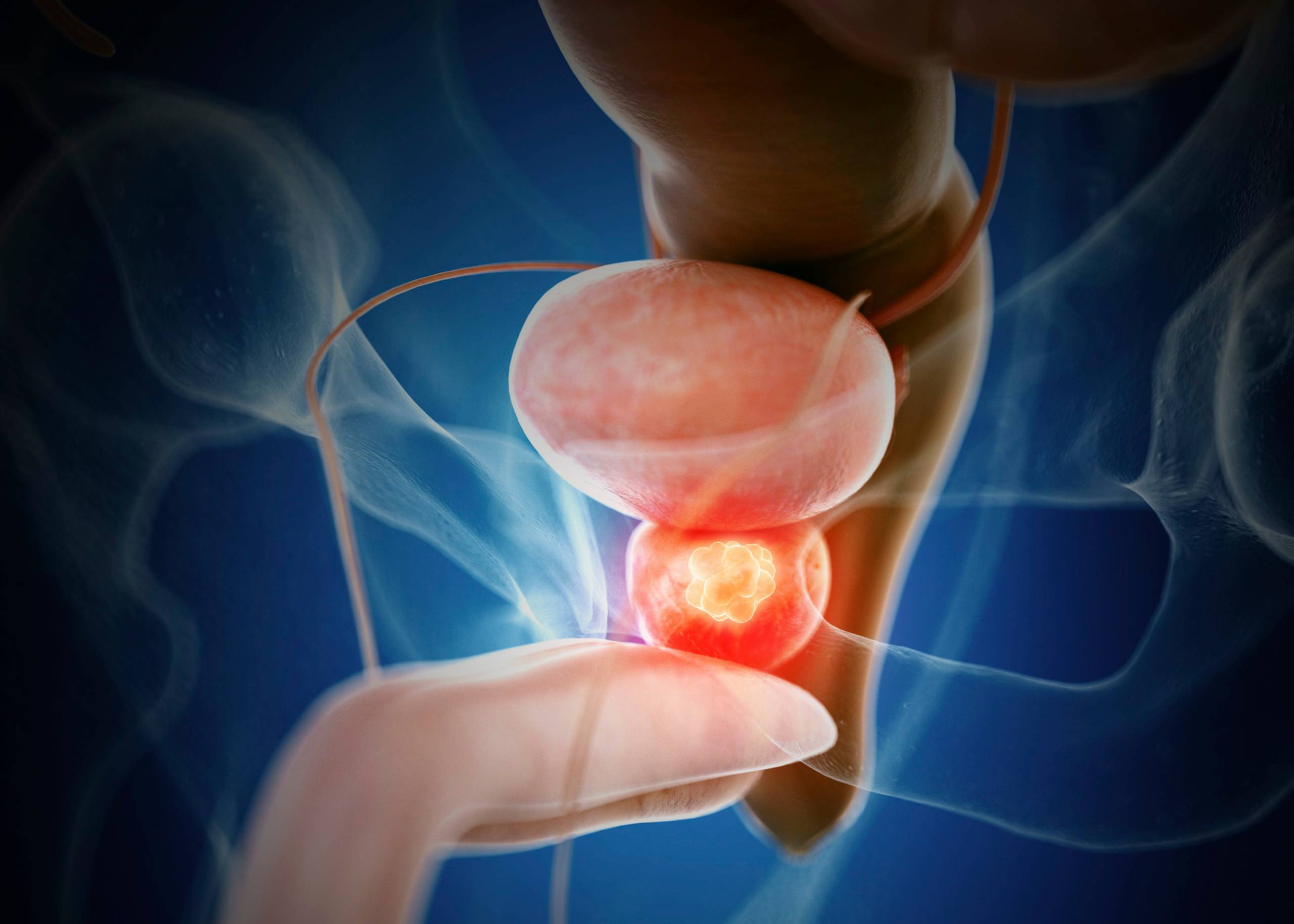 Prostate cancer in Kharghar, Navi Mumbai