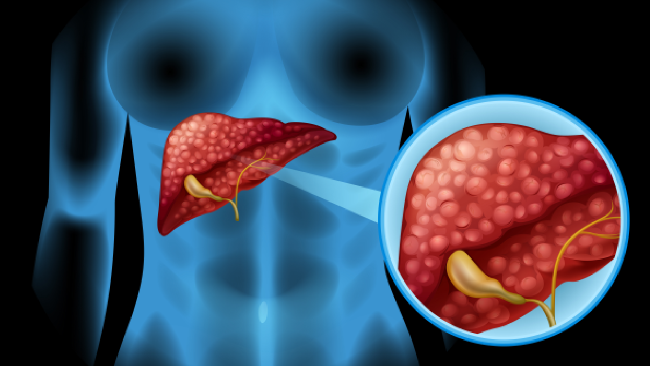 Gallstones Treament in Navi Mumbai
