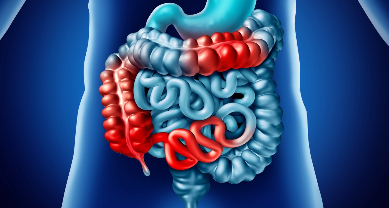 Crohn's disease treatment in Navi Mumbai
