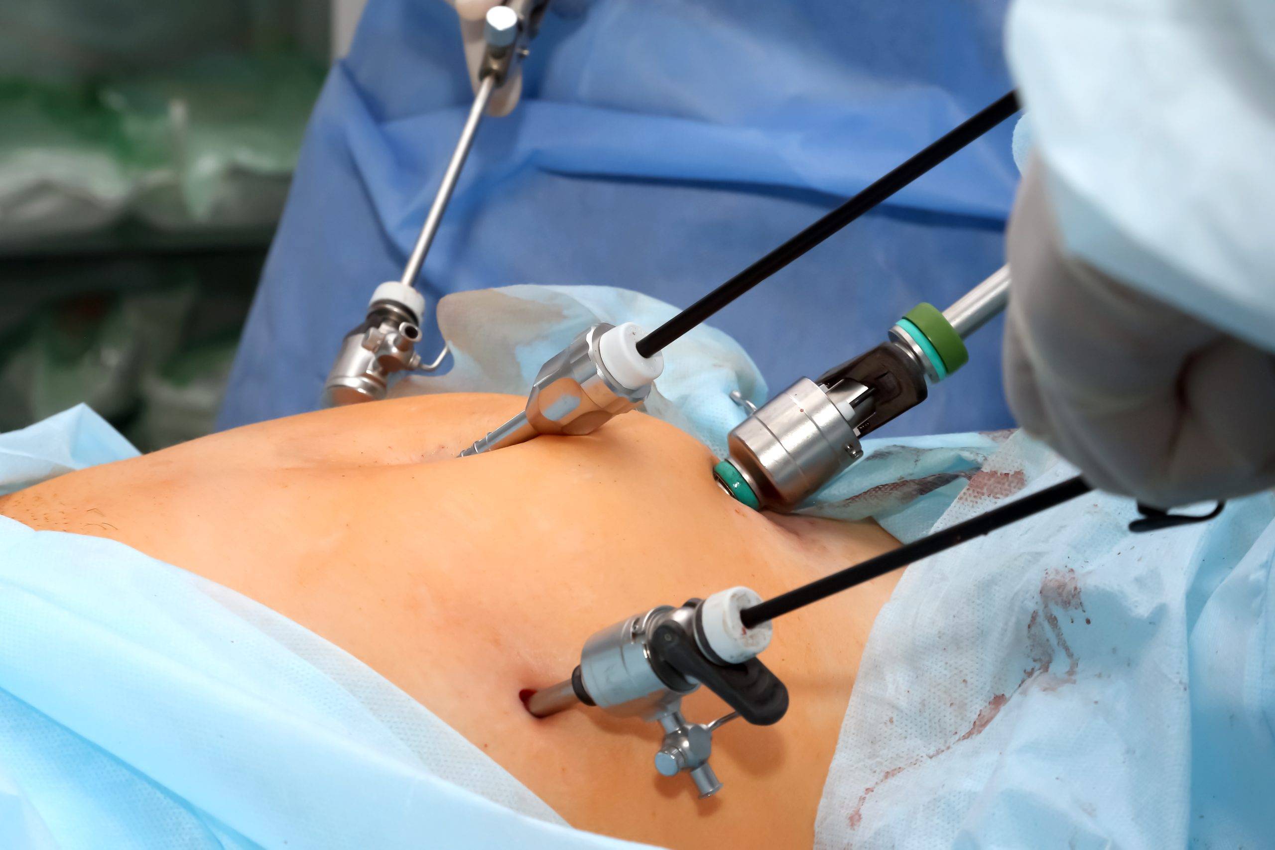 Laparoscopic Hysterectomy Surgeon in Navi Mumbai